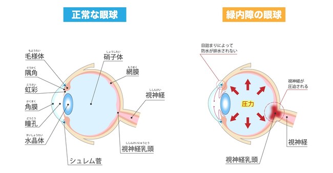 見え方の「欠け」は疲れ目じゃない!?緑内障のサインと予防法【医師解説】