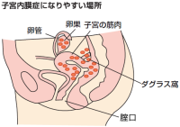 【医師監修】生理痛と月経前緊張症（PMS）を改善しよう（2/4）