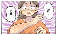 40代、目覚めると赤いボツボツがびっしり！？医師から告げられたまさかの診断【体験談】