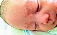 こんなときはどうすればいい？息子の乳児脂漏性湿疹エピソード
