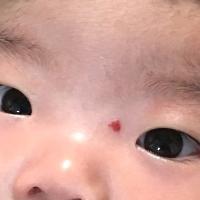 虫刺され…じゃない!?生後1カ月ごろ現れた、いちご状血管腫。「様子を見ましょう」と言われたけど…