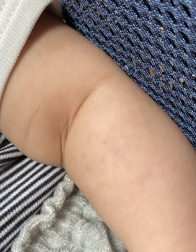腕に紫斑 医療専門家が個別回答 妊娠 出産 子育ての悩みを解決するオンライン相談 ベビーカレンダー