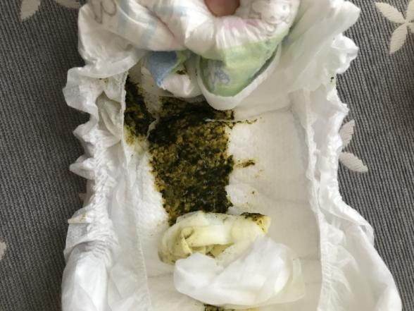 便の色について|医療専門家が個別回答 妊娠・出産・子育ての悩みを解決するオンライン相談|ベビーカレンダー