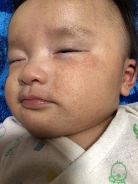 湿疹とアレルギー 医療専門家が個別回答 妊娠 出産 子育ての悩みを解決するオンライン相談 ベビーカレンダー