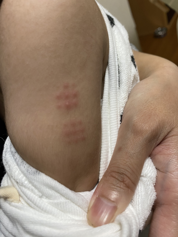 g摂取箇所の赤みについて 医療専門家が個別回答 妊娠 出産 子育ての悩みを解決するオンライン相談 ベビーカレンダー