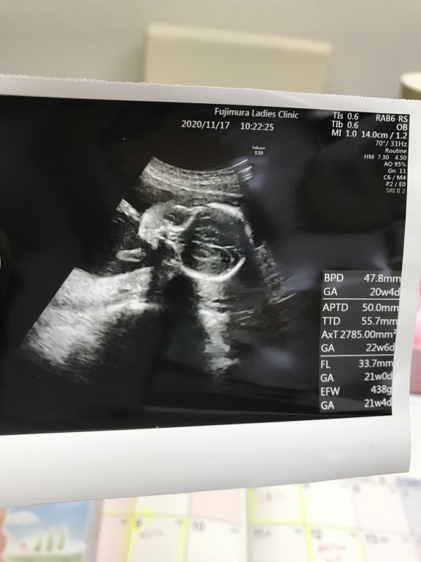 エコー写真の見方を教えてください 医療専門家が個別回答 妊娠 出産 子育ての悩みを解決するオンライン相談 ベビーカレンダー
