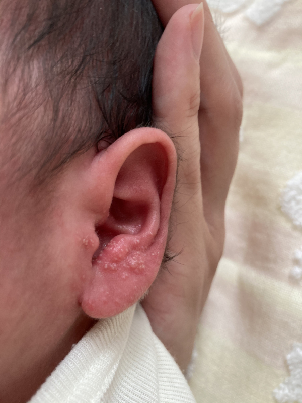 耳のぶつぶつ 医療専門家が個別回答 妊娠 出産 子育ての悩みを解決するオンライン相談 ベビーカレンダー