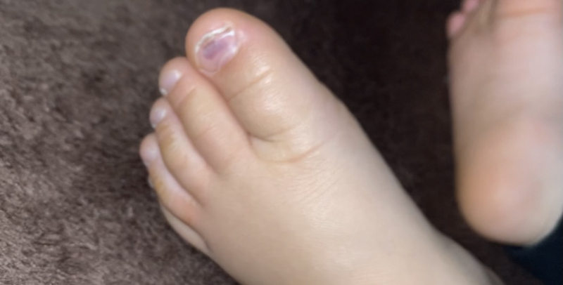 爪の内出血 医療専門家が個別回答 妊娠 出産 子育ての悩みを解決するオンライン相談 ベビーカレンダー