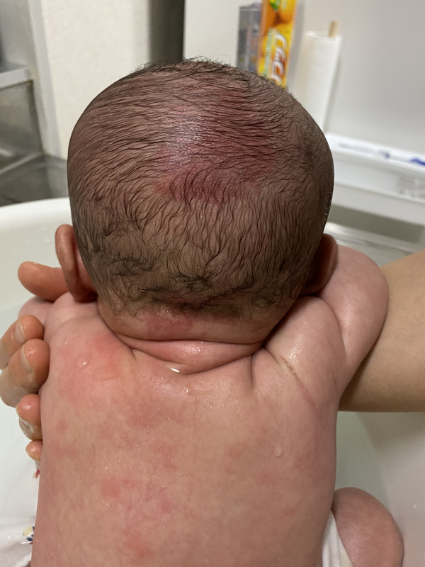 赤あざについて 医療専門家が個別回答 妊娠 出産 子育ての悩みを解決するオンライン相談 ベビーカレンダー