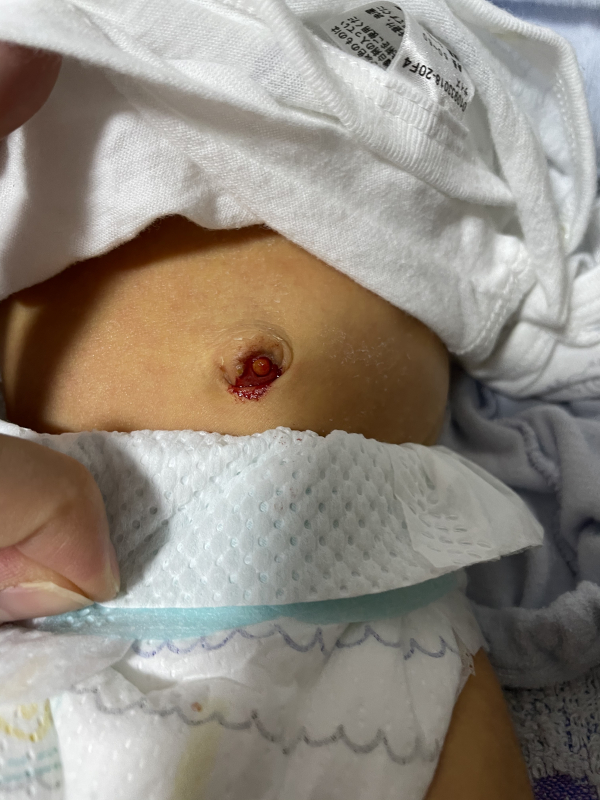 おへその出血 医療専門家が個別回答 妊娠 出産 子育ての悩みを解決するオンライン相談 ベビーカレンダー