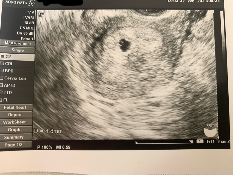 胎嚢が小さい気がします 不安です 医療専門家が個別回答 妊娠 出産 子育ての悩みを解決するオンライン相談 ベビーカレンダー