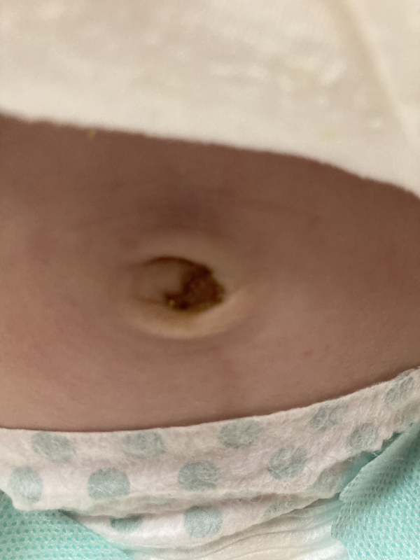 お臍の黄色いものについて 医療専門家が個別回答 妊娠 出産 子育ての悩みを解決するオンライン相談 ベビーカレンダー