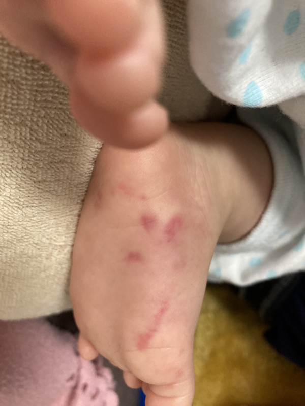 左足裏の内出血 医療専門家が個別回答 妊娠 出産 子育ての悩みを解決するオンライン相談 ベビーカレンダー