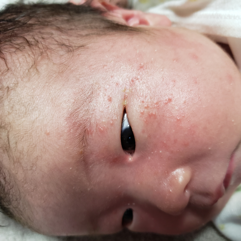 目の周りに赤いプツプツが 医療専門家が個別回答 妊娠 出産 子育ての悩みを解決するオンライン相談 ベビーカレンダー