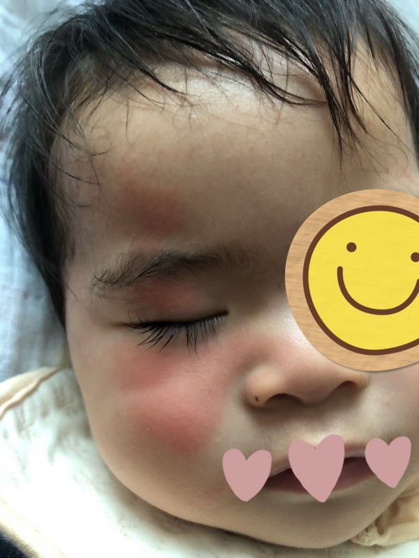 顔の赤みについて 医療専門家が個別回答 妊娠 出産 子育ての悩みを解決するオンライン相談 ベビーカレンダー