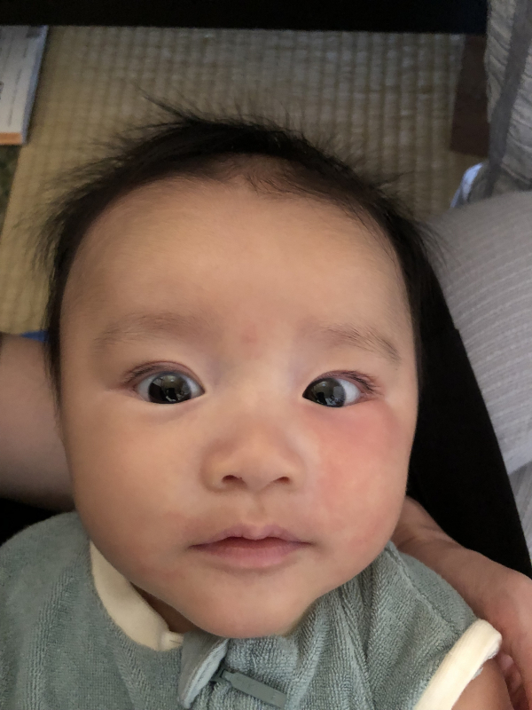 湿疹とアレルギー 医療専門家が個別回答 妊娠 出産 子育ての悩みを解決するオンライン相談 ベビーカレンダー