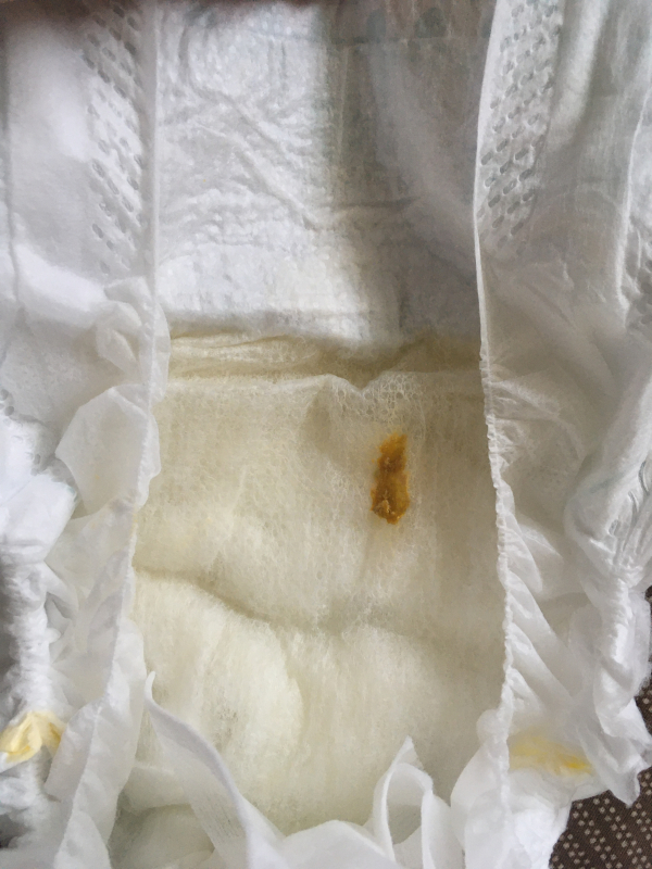 胆道閉鎖症の可能性|医療専門家が個別回答 妊娠・出産・子育ての悩みを解決するオンライン相談|ベビーカレンダー