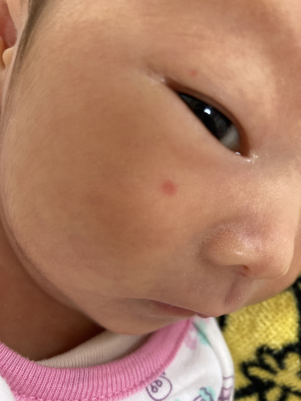 いちご血管腫 医療専門家が個別回答 妊娠 出産 子育ての悩みを解決するオンライン相談 ベビーカレンダー