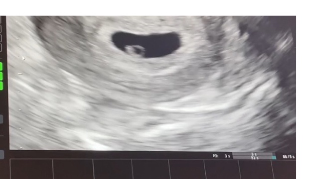 胎嚢の大きさについて 医療専門家が個別回答 妊娠 出産 子育ての悩みを解決するオンライン相談 ベビーカレンダー