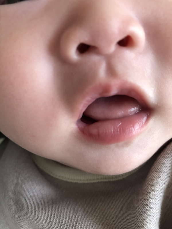 急に唇に水膨れみたいな腫れが 医療専門家が個別回答 妊娠 出産 子育ての悩みを解決するオンライン相談 ベビーカレンダー