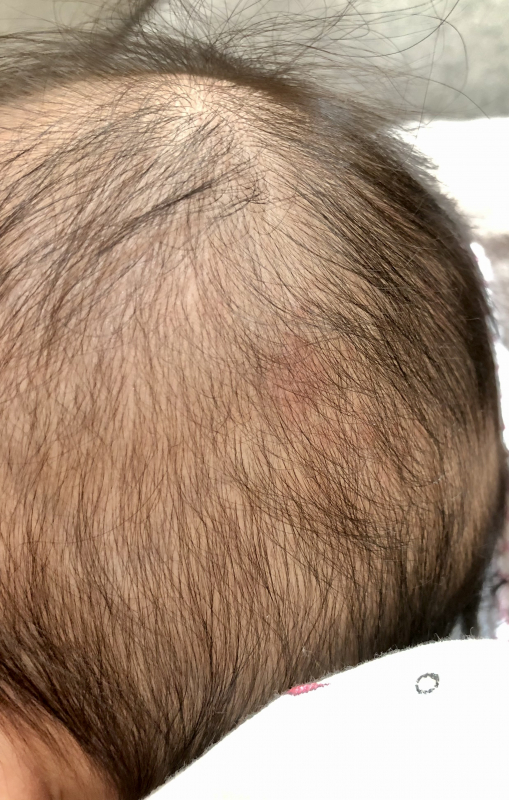 後頭部のあせもについて 医療専門家が個別回答 妊娠 出産 子育ての悩みを解決するオンライン相談 ベビーカレンダー