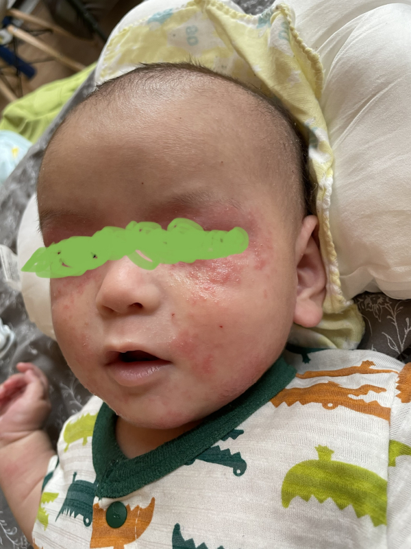 肌荒れについて 医療専門家が個別回答 妊娠 出産 子育ての悩みを解決するオンライン相談 ベビーカレンダー