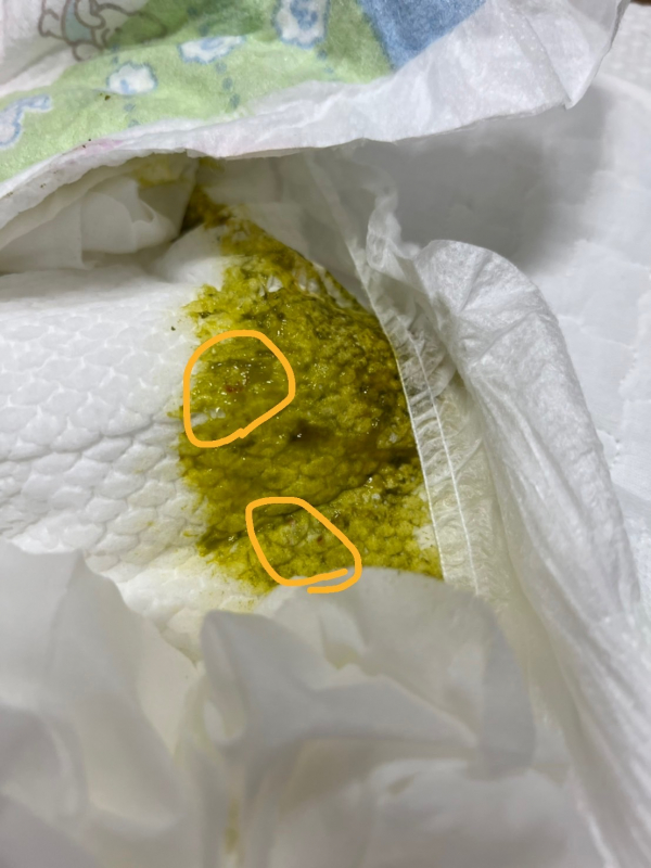 うんちに少し血が混じることについて 医療専門家が個別回答 妊娠 出産 子育ての悩みを解決するオンライン相談 ベビーカレンダー