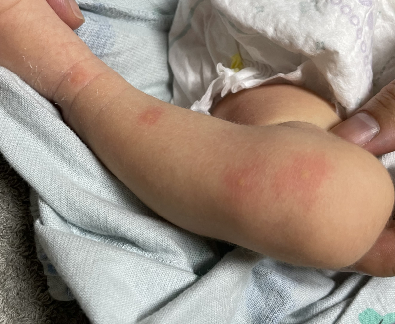 人生の肌にプツプツ 医療専門家が個別回答 妊娠 出産 子育ての悩みを解決するオンライン相談 ベビーカレンダー