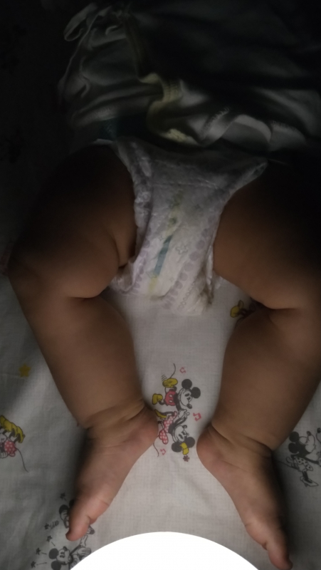 股関節脱臼について 医療専門家が個別回答 妊娠 出産 子育ての悩みを解決するオンライン相談 ベビーカレンダー