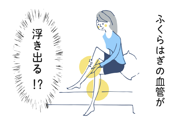 「ふくらはぎの血管が浮き出る」見た目だけじゃない！下肢静脈瘤が引き起こす体の変化とは【医師解説】