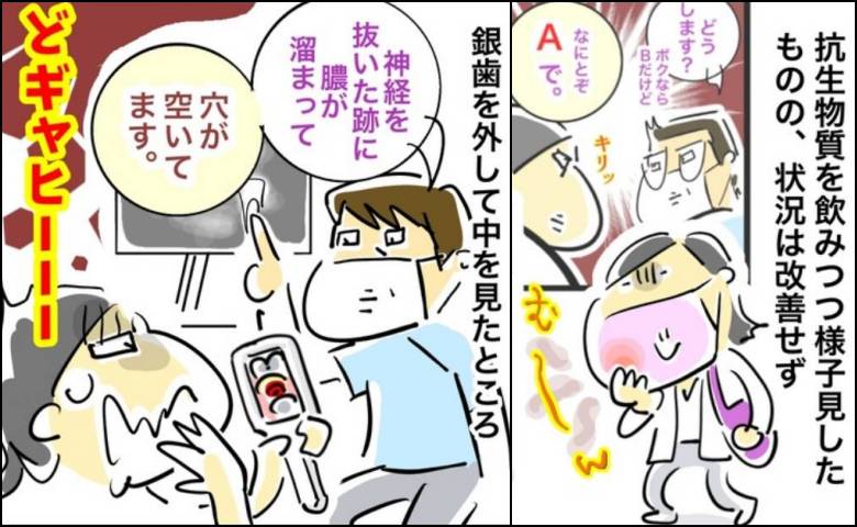 医師「膿がたまり穴が」銀歯の下の状態に絶句。私が突きつけられた究極の二択 #銀歯の下の悲劇 2