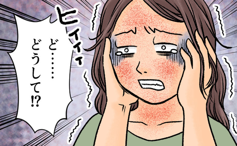 「顔が真っ赤」幼少期に落ち着いたはずなのに。40代で襲った肌の異変。腫れ上がりヒリヒリした理由は