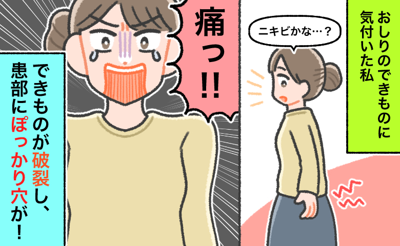 「できものが破裂」おしりの違和感を放置したら激痛。座った衝撃で破れて患部にぽっかり開いた傷の正体
