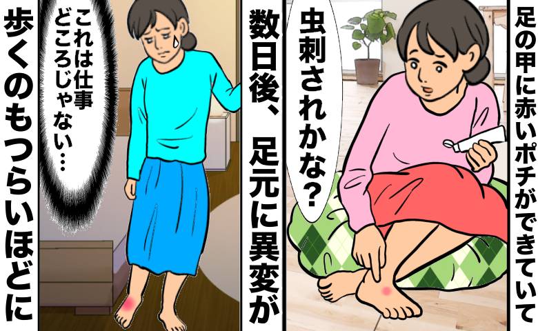 「虫刺され？」足の甲の赤いポチに塗り薬。数日後、足を引きずる痛みで受診した結果【医師解説あり】