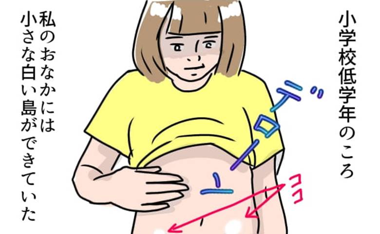 娘の尋常性白斑／フワリー