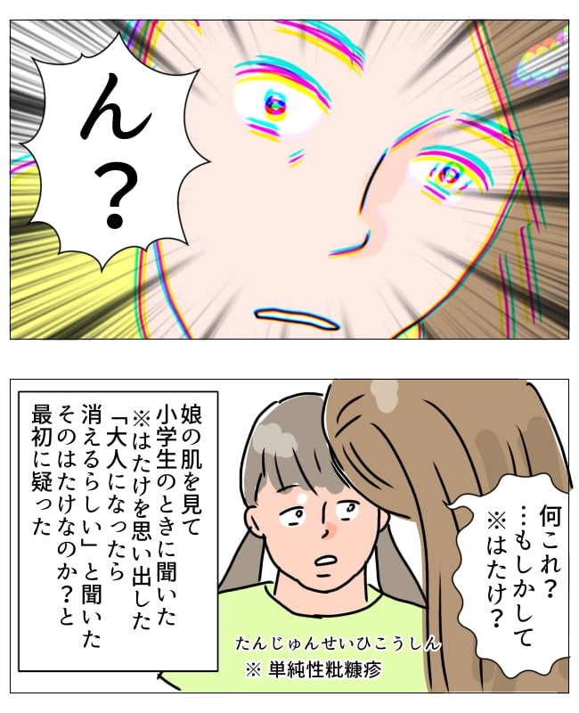 娘の尋常性白斑／フワリー