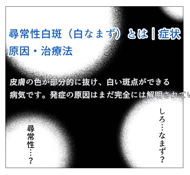 娘の尋常性白斑／フワリー