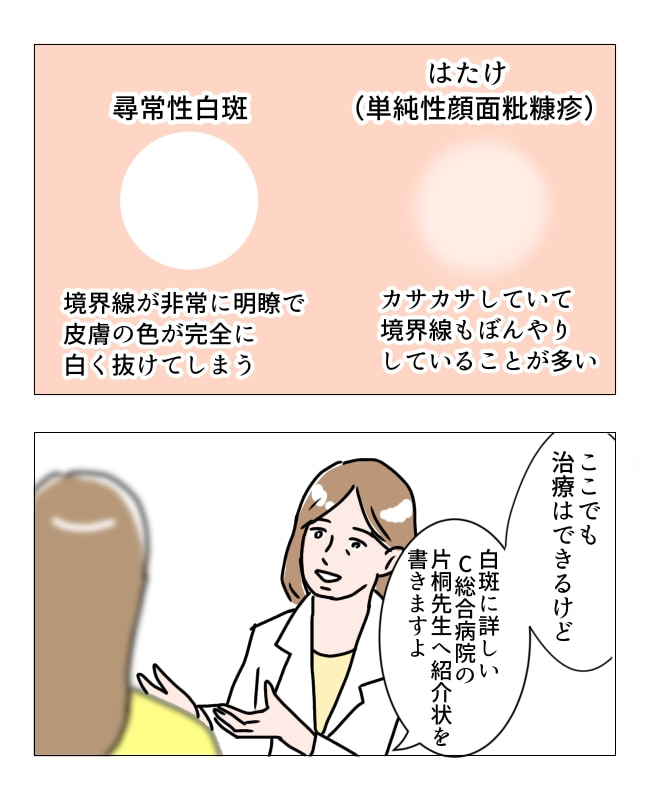 娘の尋常性白斑／フワリー
