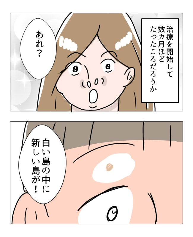 娘の尋常性白斑／フワリー