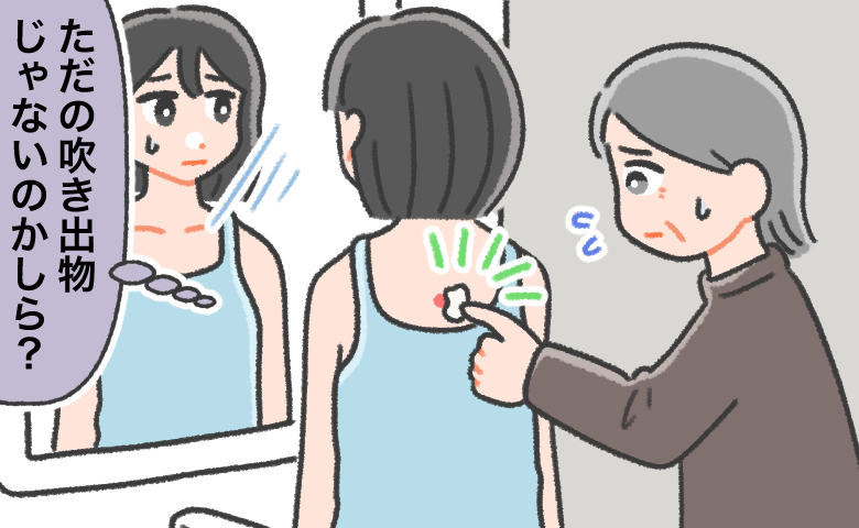 家族に手伝ってもらって背中にできた吹き出物に市販薬を塗るも、悪化していくため鏡の前で不安になる女性のイラスト