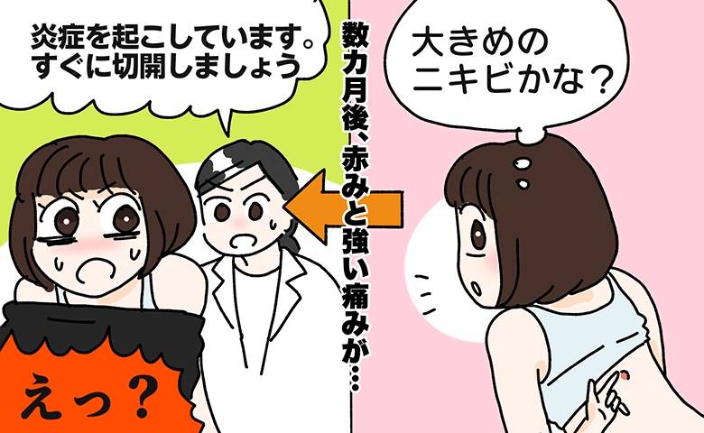 粉瘤ができた女性