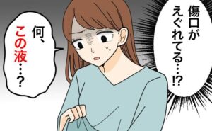 帝王切開の傷痕に謎の液が出た女性