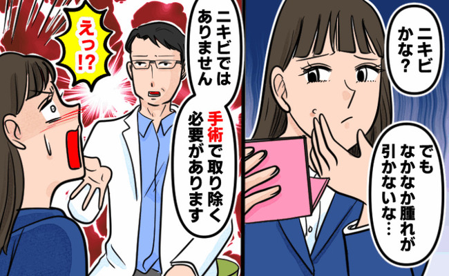 粉瘤　イメージカット