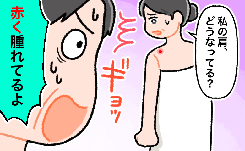 ニキビと思っていた肩の腫れものが気になり、お風呂上がりに「私の肩、どうなってる？」と尋ねる女性に対し、「赤く腫れてるよ」と驚いている夫の様子を描いたイラスト