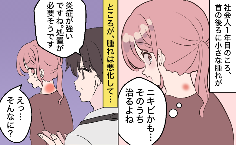 社会人一年目の頃、首の後ろに小さな腫れができ「ニキビかも…そのうち治るよね」と心の中で楽観視していた女性。その後、腫れが悪化し、医師から「炎症が強いですね。処置が必要そうです」と言われて「えっ…そんなに？」と心の中で戸惑う女性。